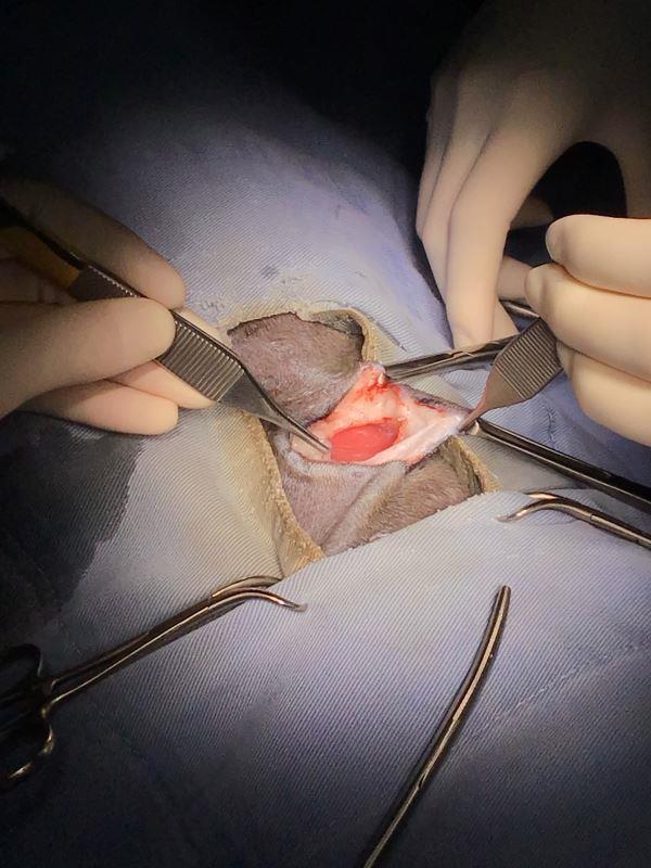 腫瘍を摘出している手術中の写真